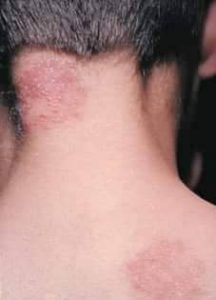 Tinea corporis treatment Symptoms and prevention