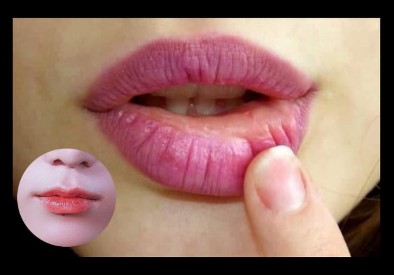 What Are The Dry Lips Causes And How To Care For Lips Healthy Life