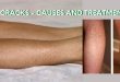 Leg_cracks_Causes_and_treatment_healthy_life_for_all