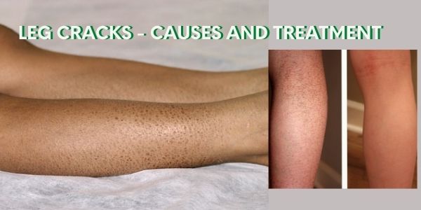 Leg_cracks_Causes_and_treatment_healthy_life_for_all